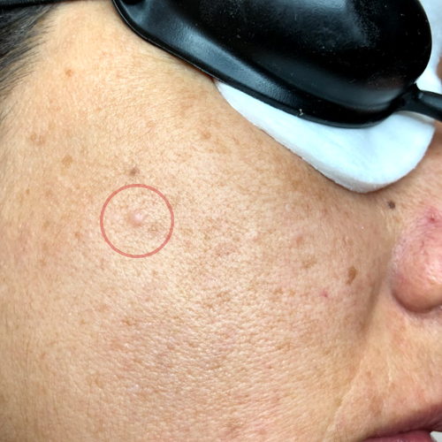 Eliminación de imperfecciones en la piel Barcelona - Hiperplasia en la cara