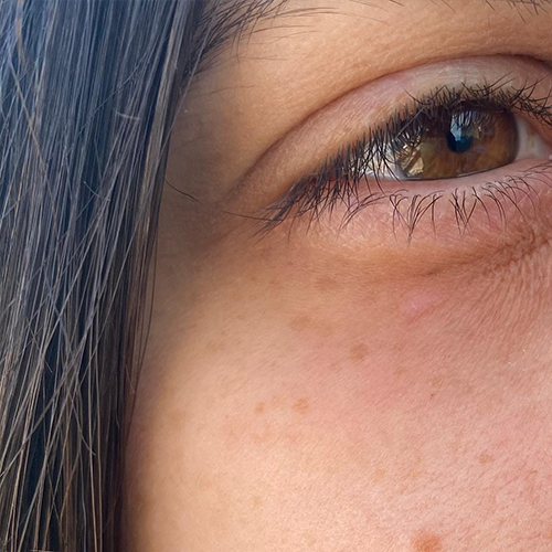 Eliminación de manchas en la piel Barcelona - Punto de rubí en el ojo